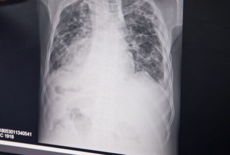 La notificación de casos de tuberculosis en España cae un 23% por la pandemia