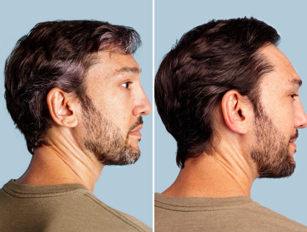Antes y después de la coloración de cabello y barba (fuente: Colorsmith)