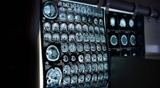 Una resonancia magnética permite ver la inflamación del cerebro en vivo por primera vez