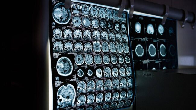 Una resonancia magnética permite ver la inflamación del cerebro en vivo por primera vez