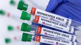 Sanidad confirma la primera muerte por viruela del mono en España